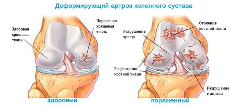 Артроз коленного сустава: лечение, диета и рекомендации