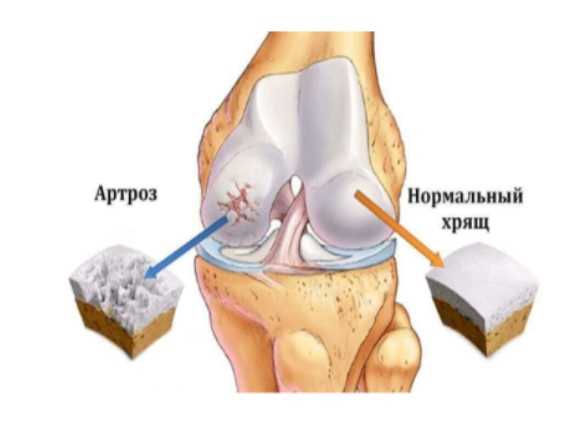 Эффективное лечение артроза левого коленного сустава 2 степени
