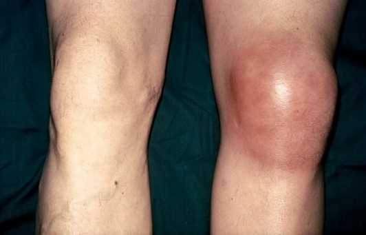 Факторы риска развития бурсита коленного сустава
