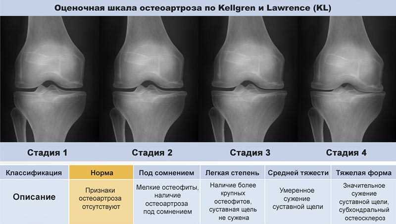 Деформирующий остеоартроз коленного сустава 1 степени: лечение и методы