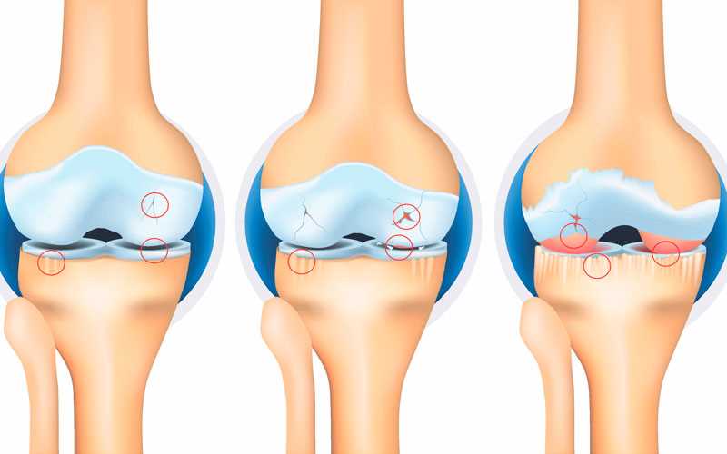 Статья о двустороннем гонартрозе 1 степени коленного сустава