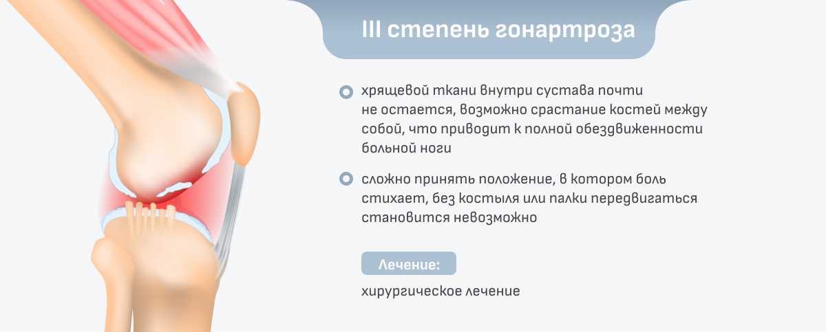 Лечение гонартроза коленного сустава 4 степени: инновационные подходы и терапевтические средства