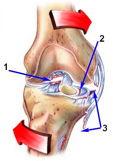 Эффективное лечение разрыва внутренней боковой связки коленного сустава