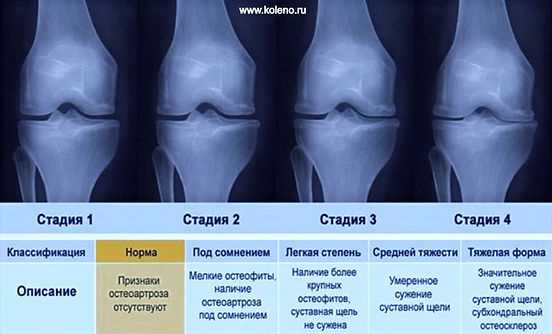 Гонартроз 1 степени коленного сустава: лечение лекарствами