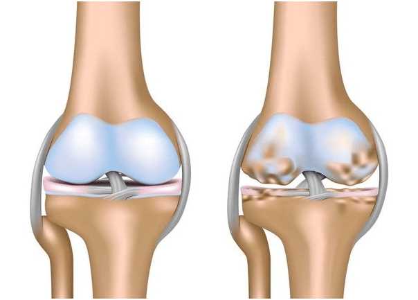Грязевое лечение артроза коленного сустава: эффективные методы и рекомендации