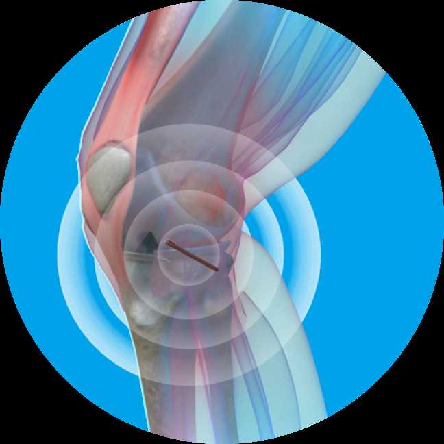 Этапы лечения коленного сустава