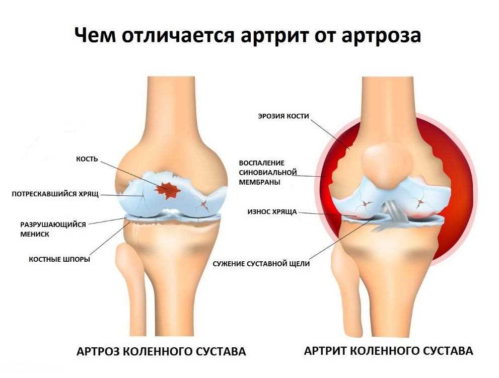 Массаж с применением жира для снятия напряжения и боли в коленных суставах