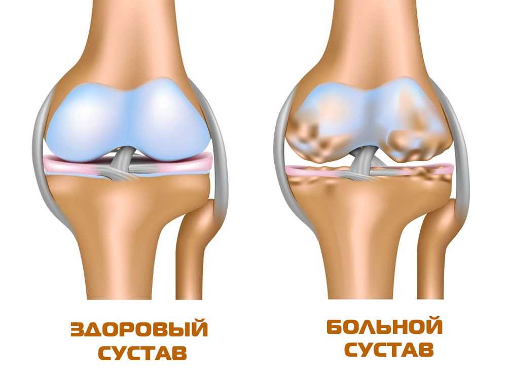 Эффективные методы лечения болезни гоффа коленного сустава без хирургического вмешательства!