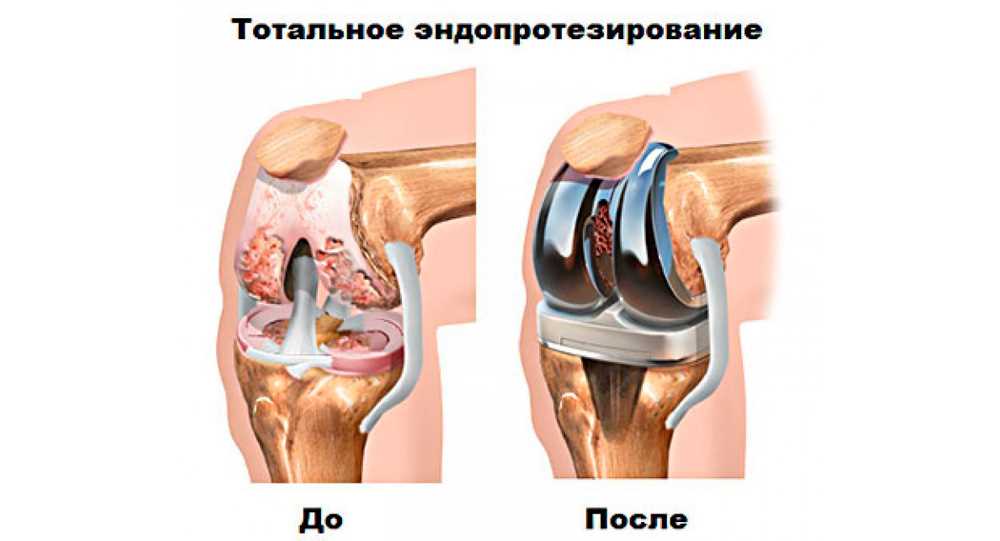 Артроскопия коленного сустава для лечения гонартроза
