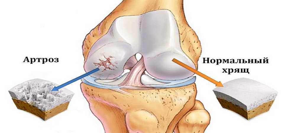 Эффективные процедуры в лечении гонартроза коленного сустава