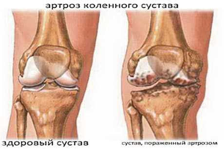 Эффективные методы лечения обострения артрита коленного сустава