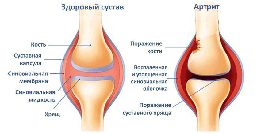 Эффективные методы лечения обострения артрита коленного сустава