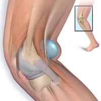 Симптомы кисты Бейкера коленного сустава
