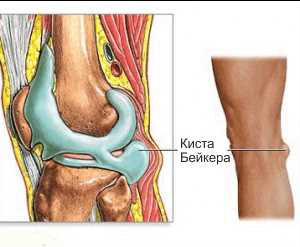 Немедикаментозные методы лечения кисты Бейкера коленного сустава