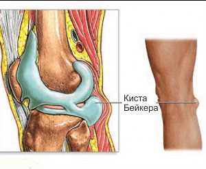 Киста Бейкера коленного сустава: симптомы и эффективное лечение