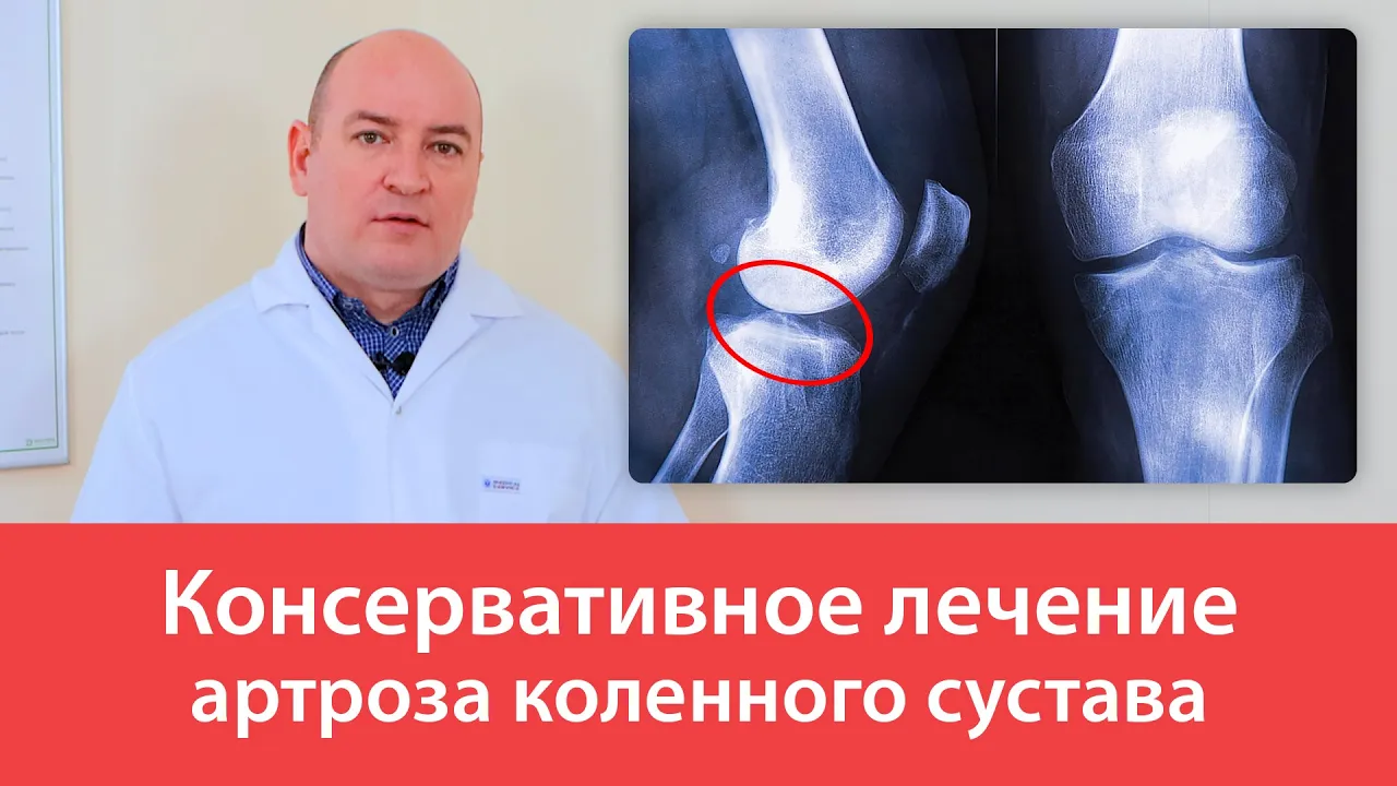 Исследование эффективных методов и препаратов для лечения артрита и артроза коленного сустава