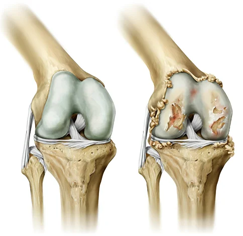 Лечение артроза коленного сустава: эффективные видео-методы и упражнения