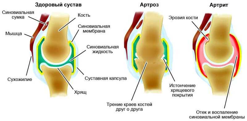 Лечение артроза коленного сустава в Екатеринбурге на Уралмаше