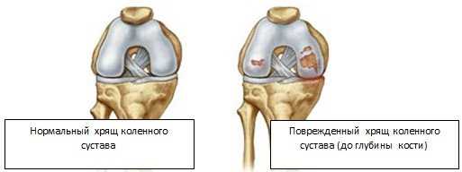 Что такое артроз коленного сустава?