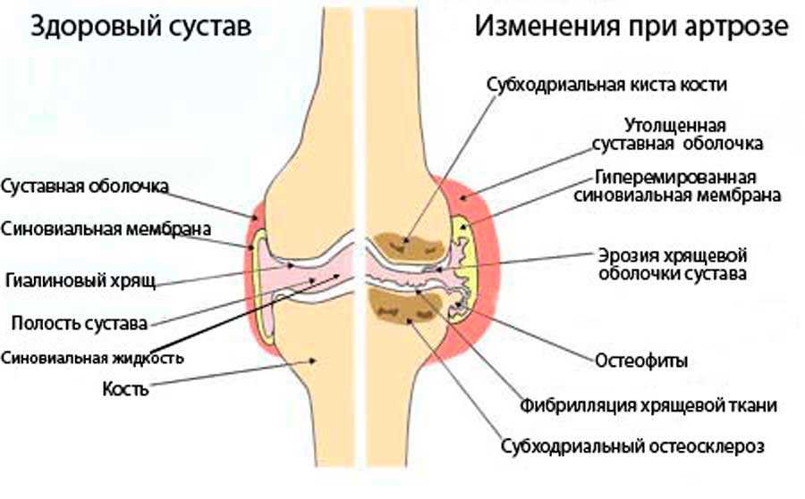 Схема лечения гонартроза коленного сустава 3 степени