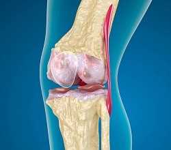 Лечение деформирующего артроза коленного сустава 3 степени