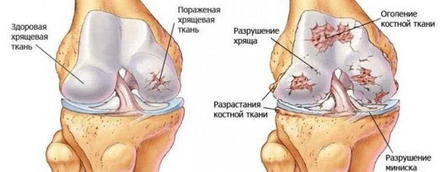 Методы лечения деформирующего артроза коленного сустава