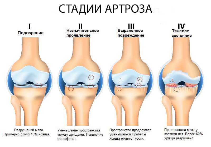 Консервативное лечение артроза коленного сустава