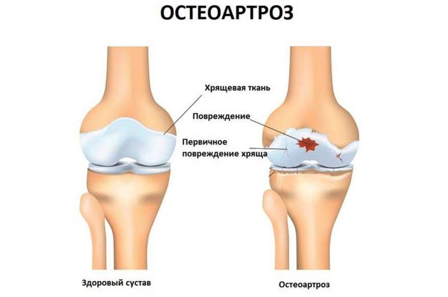 Определение артроза коленного сустава