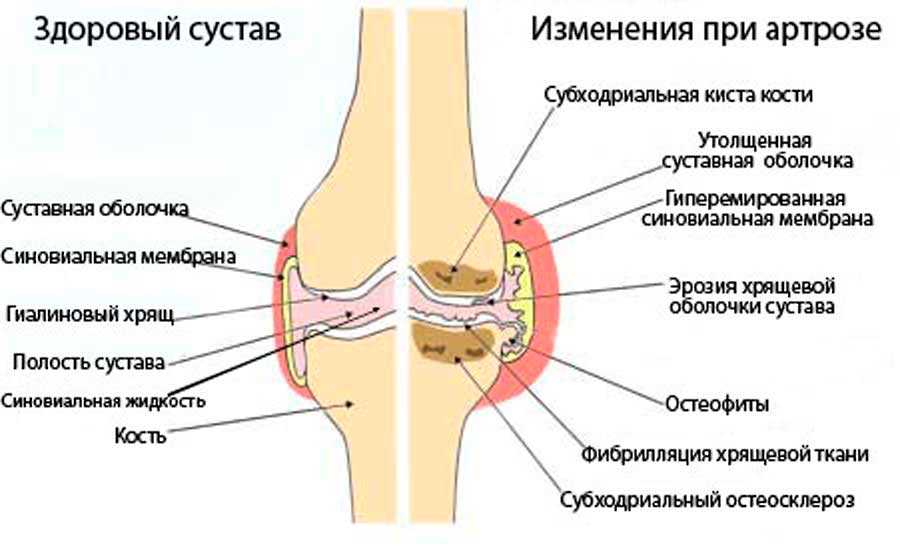 Лечение деформирующего артроза коленного сустава различных степеней