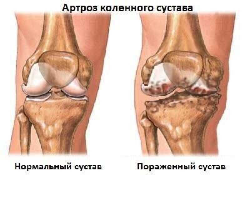 Лечение деформирующего остеоартроза коленного сустава 2 степени