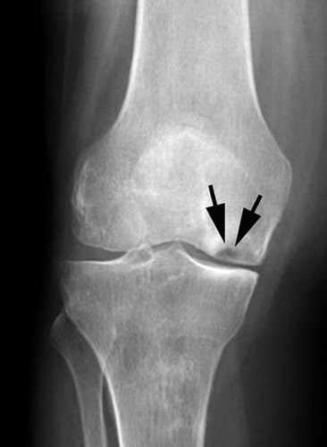 Симптомы фабеллы коленного сустава