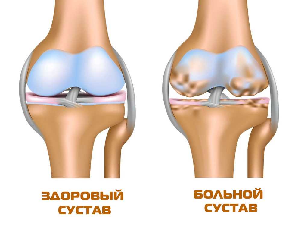 Симптомы гемартроза коленного сустава