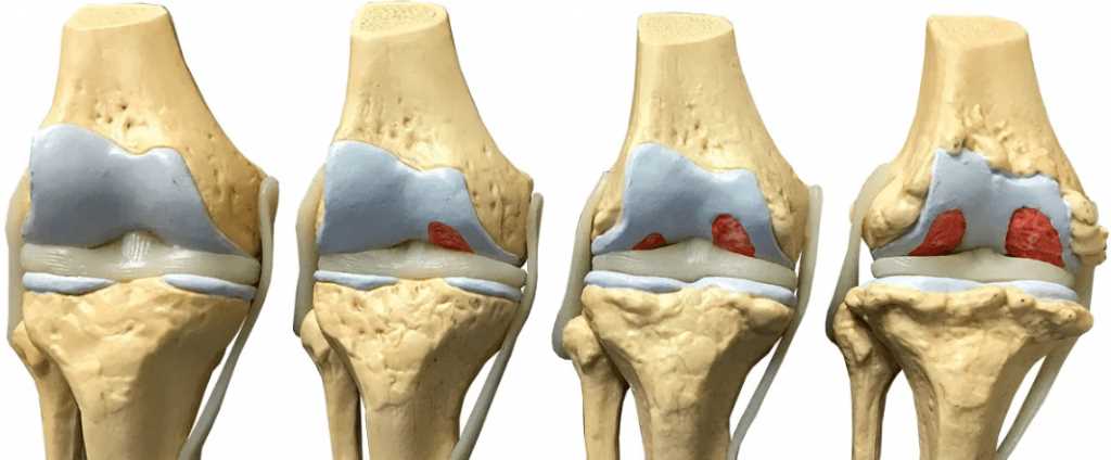 Эффективные методы восстановления при гонартрозе коленного сустава