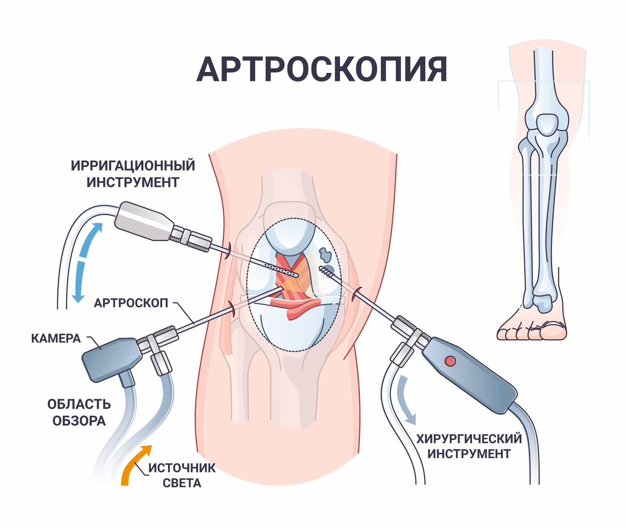 Лечение коленных суставов рентгеном