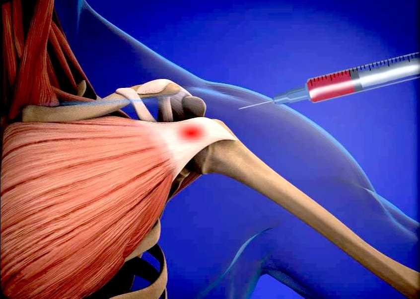 Инновационные методы лечения коленных суставов