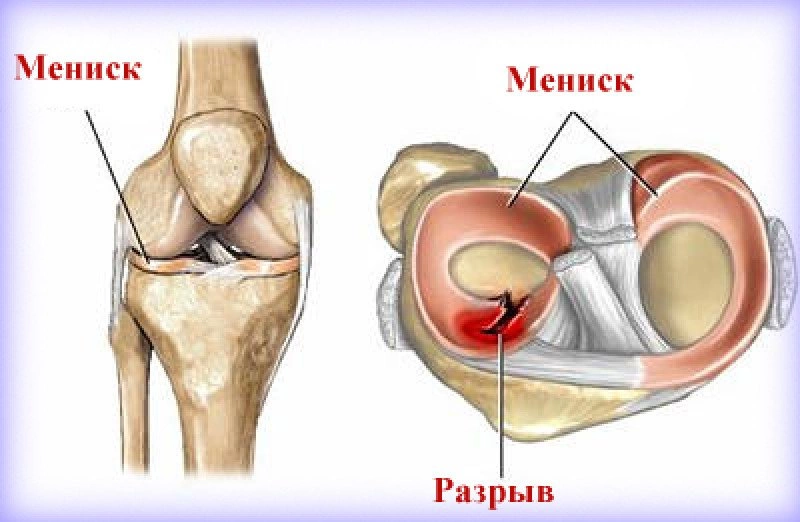 Рекомендации и методы восстановления после менискэктомии коленного сустава