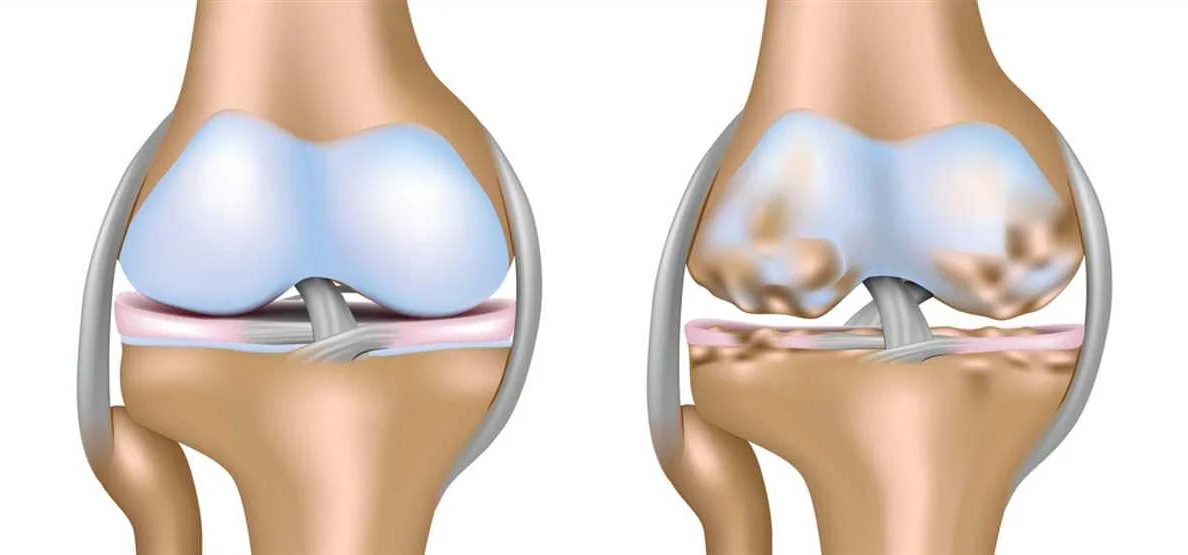 Основные симптомы окопником суставов коленных суставов