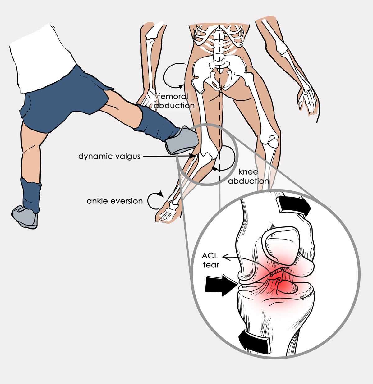 Лечение разрыва связок коленного сустава: операция и реабилитация