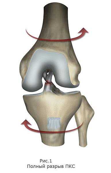 Разрыв задней крестообразной связки коленного сустава: симптомы и диагностика