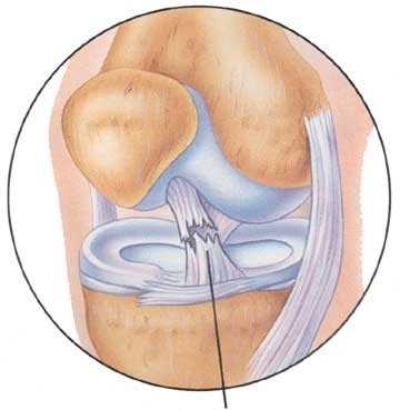 Физиотерапия при лечении разволокнения передней крестообразной связки коленного сустава