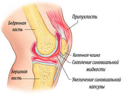 Реактивный синовит коленного сустава