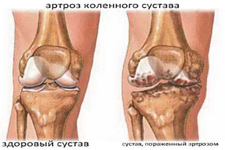 Лечение смт коленного сустава эффективные методы и рекомендации