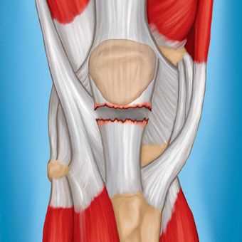Медикаментозная терапия тендиноза коленного сустава
