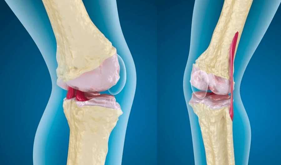 Наиболее эффективные мази для лечения вывиха коленного сустава: