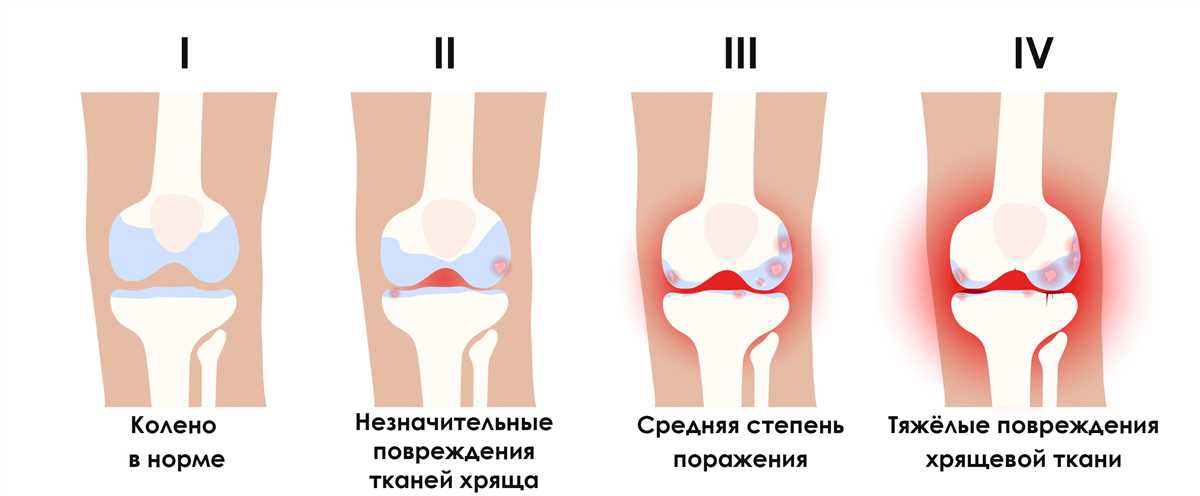 Протокол лечения коленного сустава