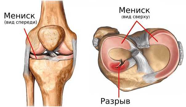 Боль и отек внутренней части колена