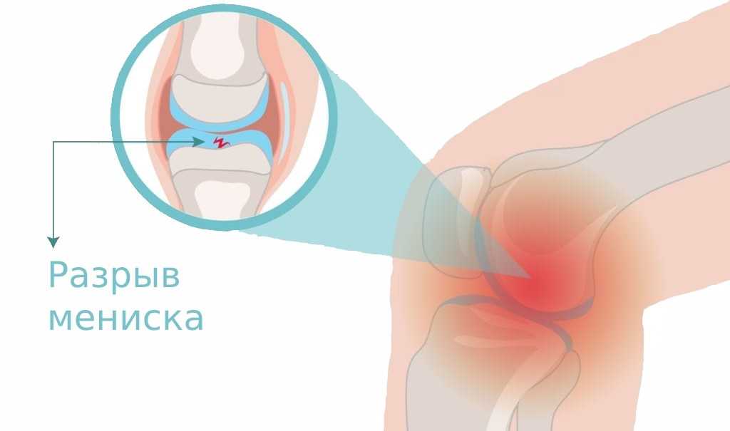 Мениска коленного сустава: повреждение, симптомы и лечение