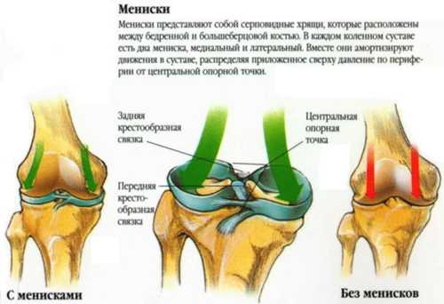 Менископатия коленного сустава: симптомы, лечение, причины