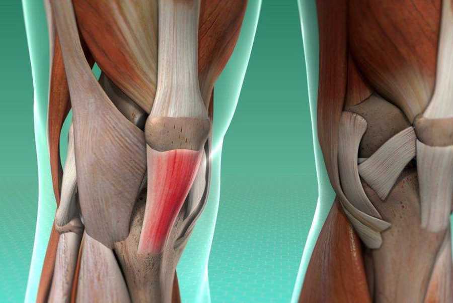 Применение мазей для лечения разрыва связок коленного сустава
