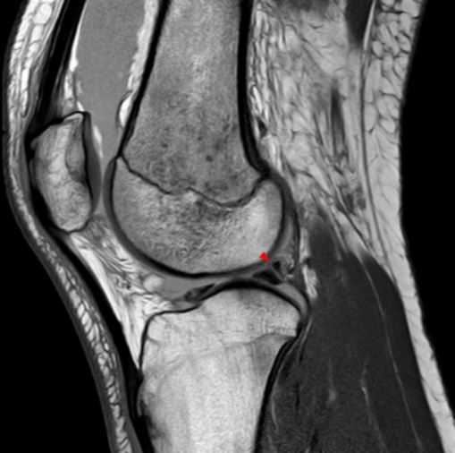 Лечение коленного сустава с помощью МРТ